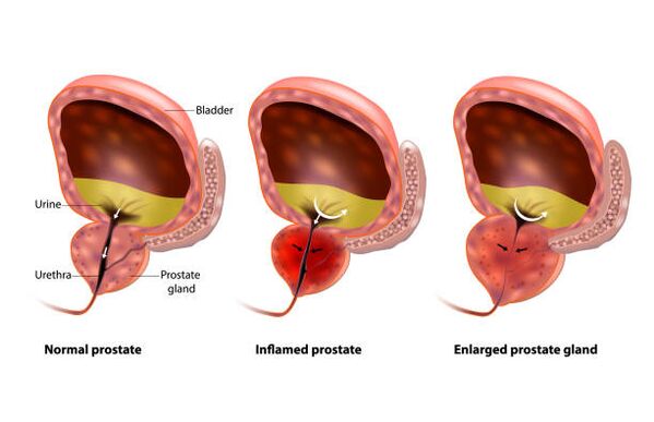 Prostatate ami megjelenik Gyertyák és olaj prosztatitis