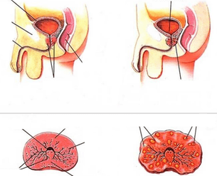 normalna prostata i kronični prostatitis